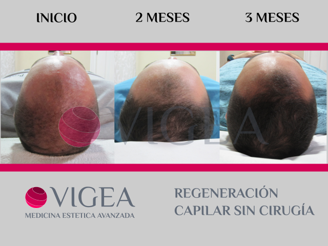 regeneracion capilar sin cirugia mesoterapia capilar almeria granada