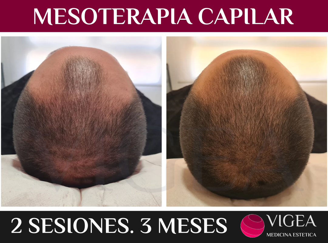 mesoterapia_capilar_almeria_caida_pelo_septiembre